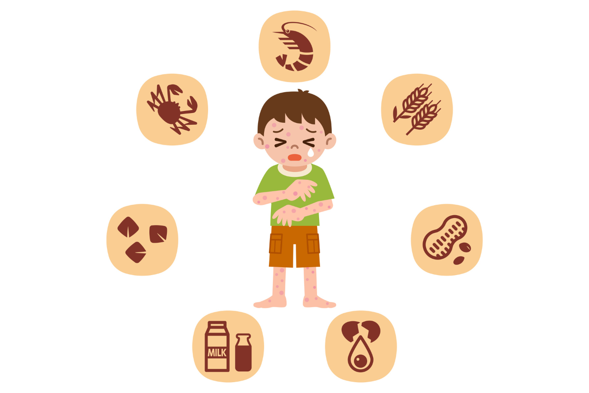 A child having an allergic reaction with common allergens displayed in Texas.