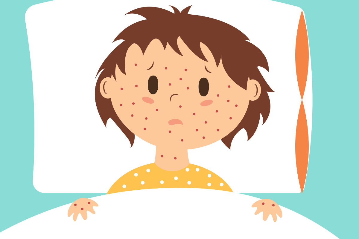 A child with small red spots all over her body and a high fever has been diagnosed with chickenpox and is resting in bed in Houston, Texas.